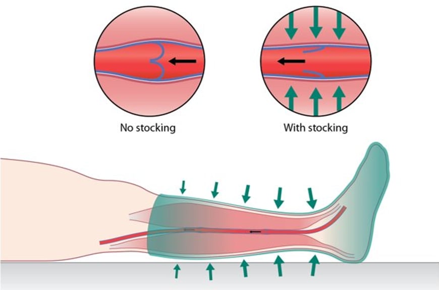 How to reduce the risk of Deep Vein Thrombosis with AES